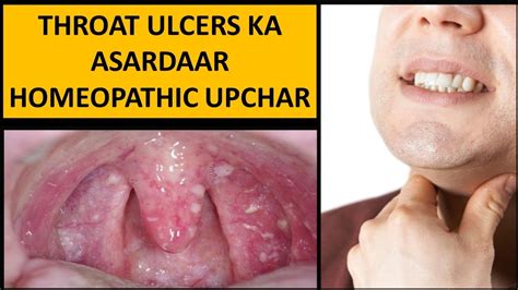 Throat Ulcer Homeopathic Treatment Throat Ulcer Symptoms Throat