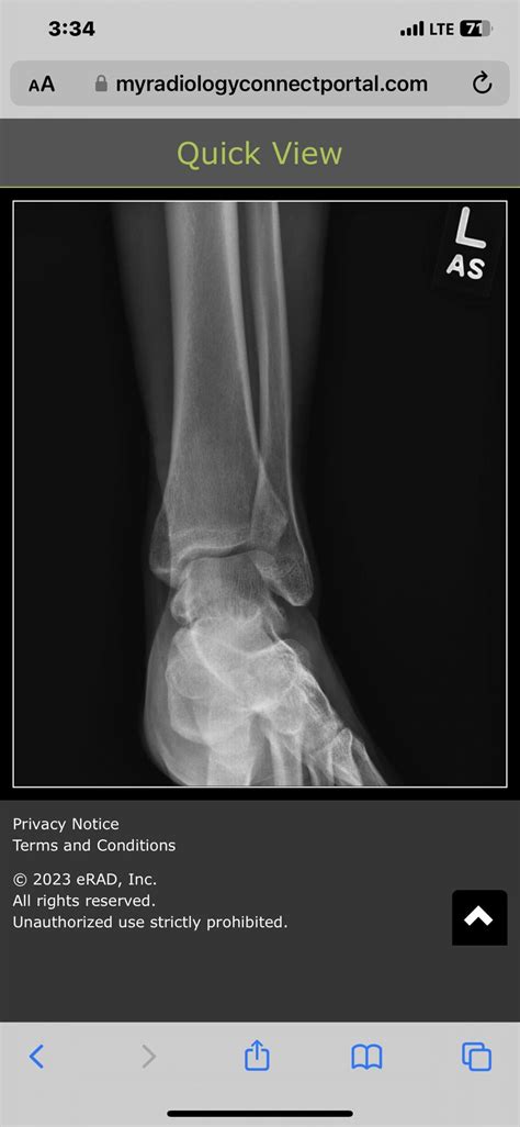 Any Arf Docs That Can Review My Ankle X Rays Page 1 AR15 COM