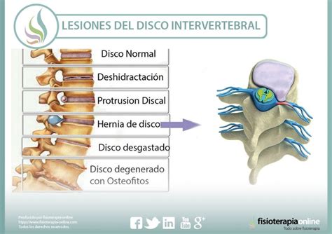 Lesiones Más Frecuentes Del Disco Intervertebral Fisioonline