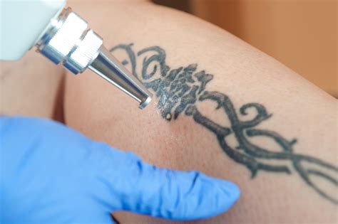 11 Things You Should Know About Laser Tattoo Removal Alma Lasers