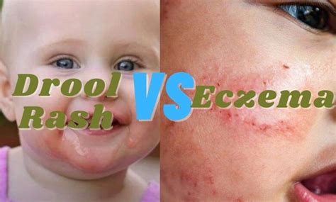 Difference Between Heat Rash And Eczema In Babies