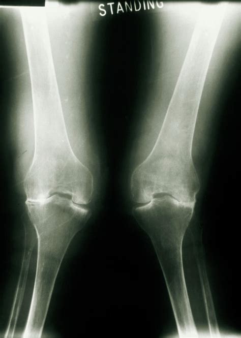 X Ray Of Knee Joints With Rheumatoid Arthritis Photograph By Medical Photo Nhs Lothianscience