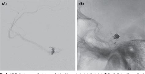 Figure 3 From Transvenous Target Embolization For A Small Sized Non