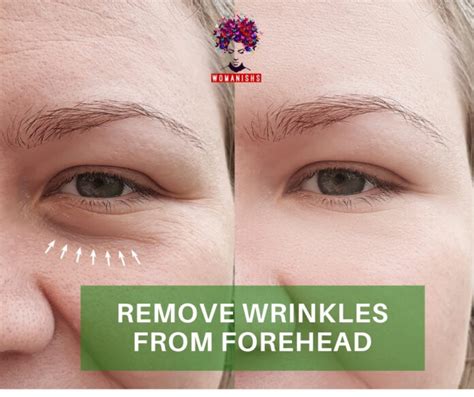 How To Remove Wrinkles From Forehead Best Guide