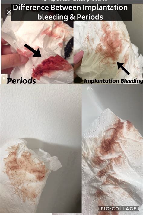 Anyone Experienced Implantation Bleeding Like This