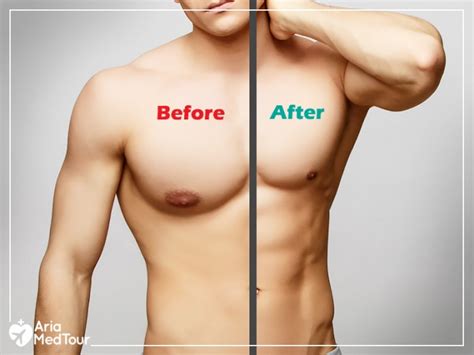 How To Get Rid Of Gynecomastia All Treatment Options Ariamedtour