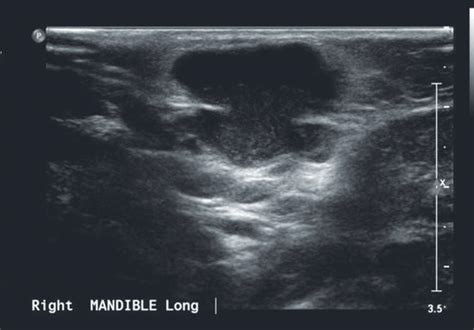 Neck Masses In Children Acquired Neck Masses Ento Key