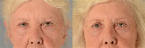 Oculoplastic Surgery Before And After Photo Gallery Tallahassee Fl