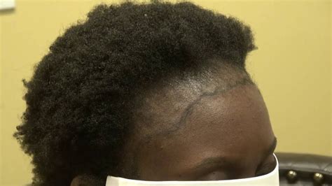 Army finally lifted its ban on dreadlocks : Kenyan Woman Black Curly Hair Restoration Hairline Transplant Dr. Diep www.mhtaclinic.com - YouTube