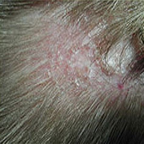 Itchy Rash On Scalp Pictures Photos