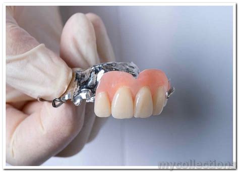 Pictures Of Partial Dentures For Front Teeth Restoring Your Smile