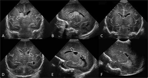 Grade I Gmh Ivh Ac Ultrasound Scan In A Preterm Infant Ga 26