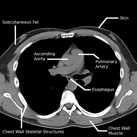 42 Chest Wall Muscle Anatomy Radiology  Altravoceilblog