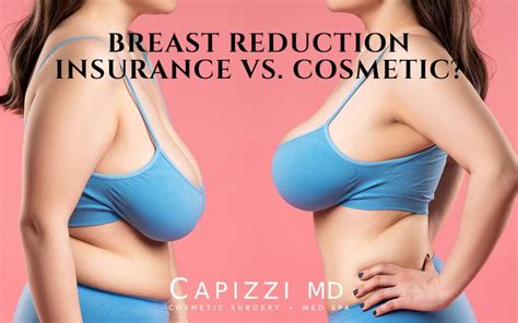 Insurance Requirements For Breast Reduction Know Your Rights Lifestyle Web Paper