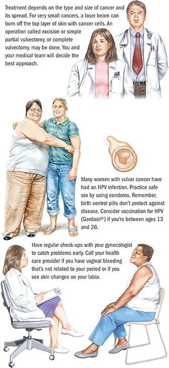 Vulvar Cancer Spectrum Health