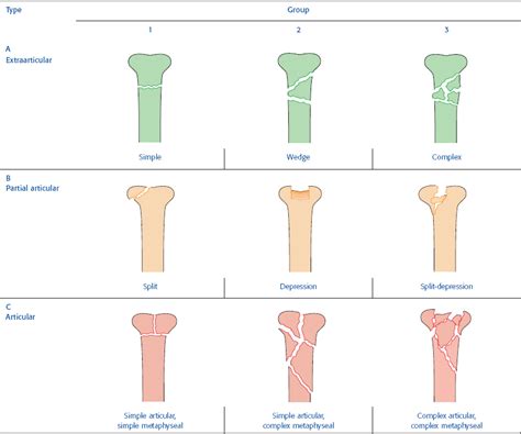 22 Fracture Classification Musculoskeletal Key