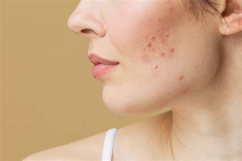 How To Treat Hormonal Acne Dallas Dermatology Partners