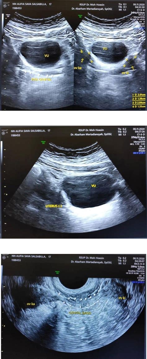 Figure From Laparoscopic Davydov Procedure For Creation Of Neovagina