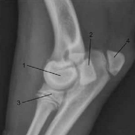 Lateral Elbow Radiographs Illustrating The Development Of The Medial