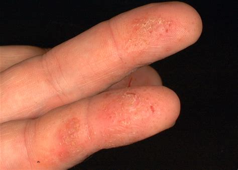 Mild Dermatitis On Hands