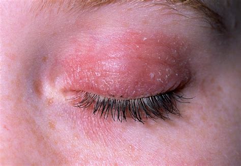 Eczema On Eyelid Bild Kaufen 11838753 Science Photo Library