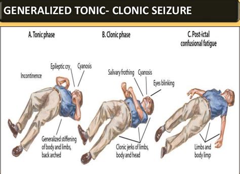 What Are Myoclonic Seizures Grand Mal Seizures