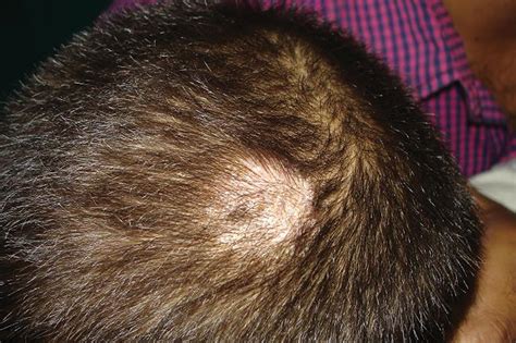 Ringworm On The Head Pictures Photos