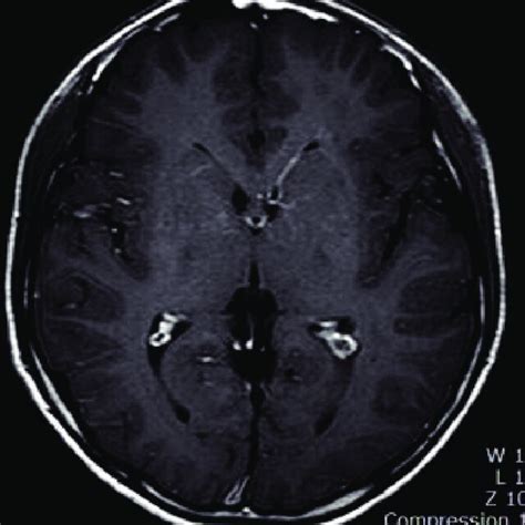 A Contrast Enhanced T1 Weighted Magnetic Resonance Imaging Showing An