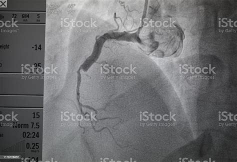 Rechte Koronare Angiographie Rechte Koronare Erkrankung Stockfoto Und