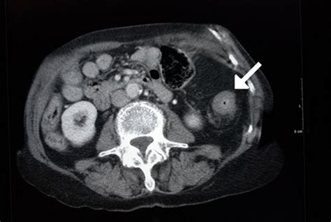 Abdominal Ct Showing An Ischaemic Stricture Of The Colon Arrow