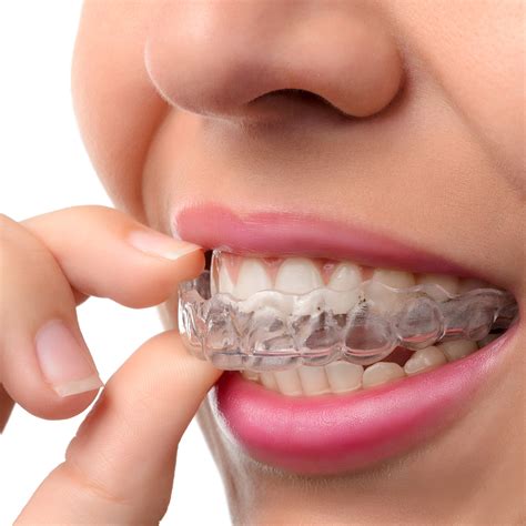 Invisible Braces Invisalign And Mtm Brace Systems