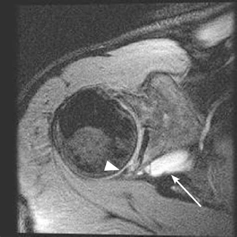 Axial Magnetic Resonance Image Of A Shoulder With A Paralabral Cyst