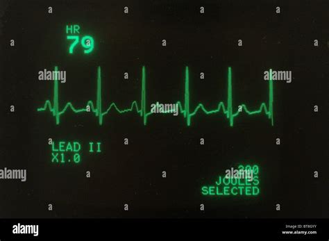 Screen Showing A Patients Heart Rate Monitor In A Hospital Ward Stock