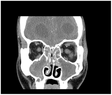 Figure 1 Ct Scan Of Bilateral Orbits And Sinuses Indicating Pan