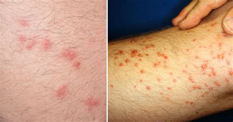 Images Of Bed Bug Bites On Humans See Spider Bite Pictures And Learn