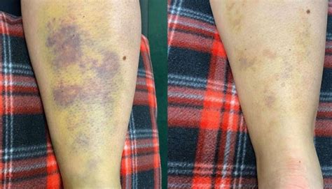 Muscle Contusion Bruise कोणत्याही दुखापतीशिवाय तुमच्याही शरीरावर