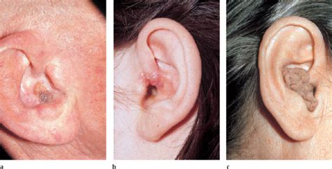 Skin Cancer On Ear Cartilage