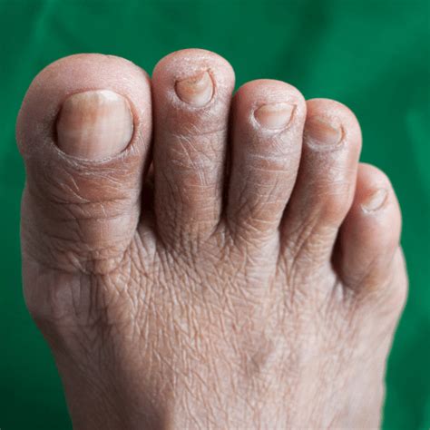 What Do Your Toenails Tell About Your Health Grandville Foot And Ankle