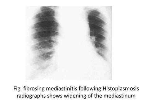 Imaging In Fungal Infection Of Chest