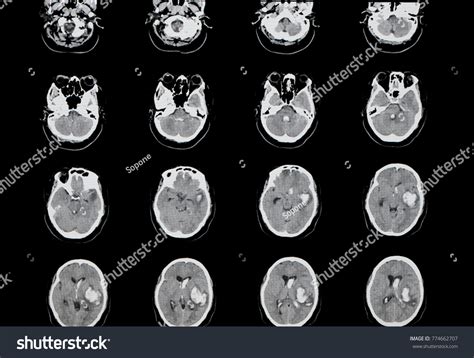 Brain Computer Tomography Ct Scan Patient Stock Photo 774662707