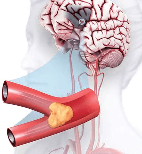 Brain Stroke How To Prevent Brain Stroke Veledora Health