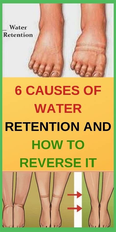 6 Causes Of Water Retention And How To Reverse It Shape Your Body In 2020 Water Retention