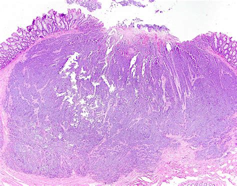 Pathology Outlines Poorly Differentiated Neuroendocrine Carcinoma