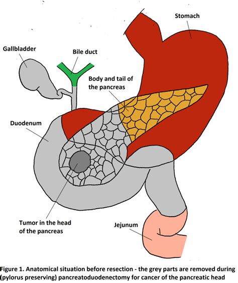 The Pancreatic Anastomosis An Overview Of Different Anastomosis