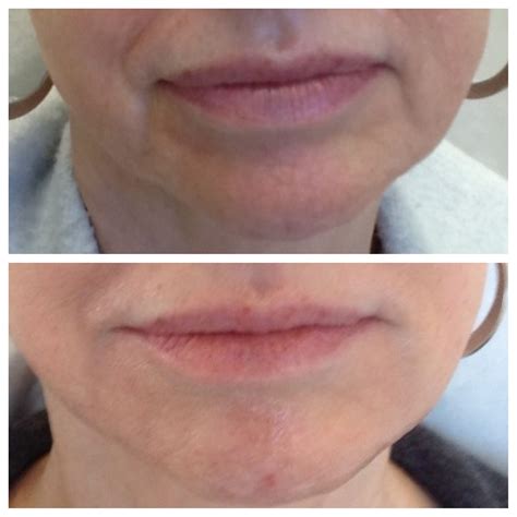 Marionette Lines Afterjuvederm Injections Wow