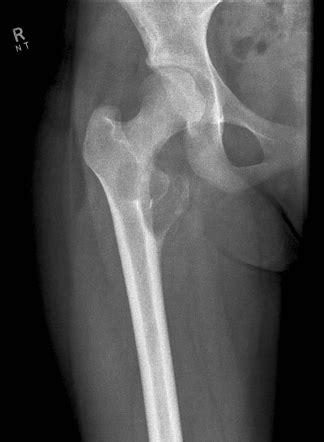 Aneurysmal Bone Cyst Radiology Reference Article Radiopaedia Org