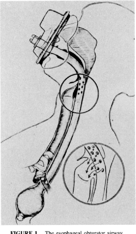 Figure 1 From The Role Of The Esophageal Obturator Airway In