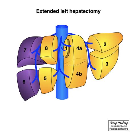Hepatectomy And Sectionectomy Diagram Image