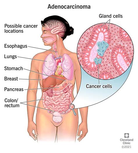 Adenocarcinoma Cancers Symptoms Causes Diagnosis And Treatment