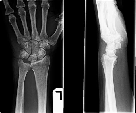Pisiform Fracture An Uncommon Wrist Injury Bmj Case Reports